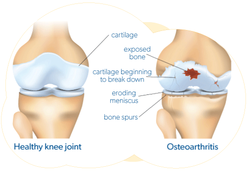Healty knee joint and damaged asteoarthritis knee