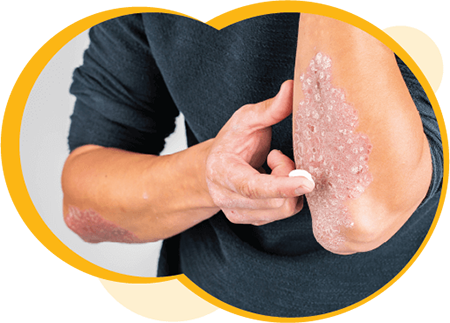 A person with medium-light skin applying a topical cream to a patch of psoriasis on their forearm.