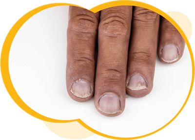 A close up of four fingers with medium skin showing pitted fingernails and nail ridges.